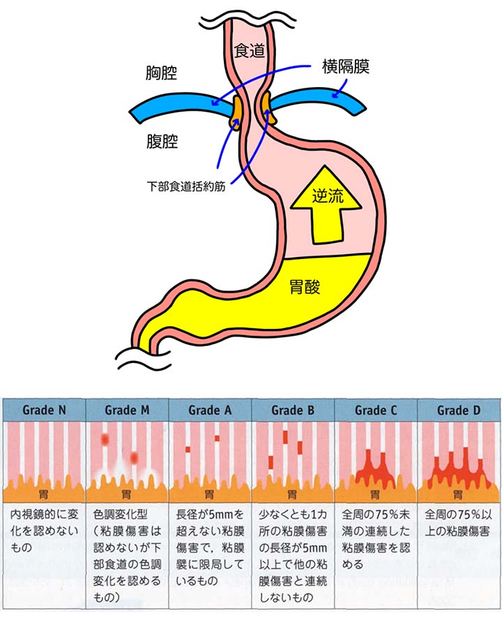 逆流性食道炎