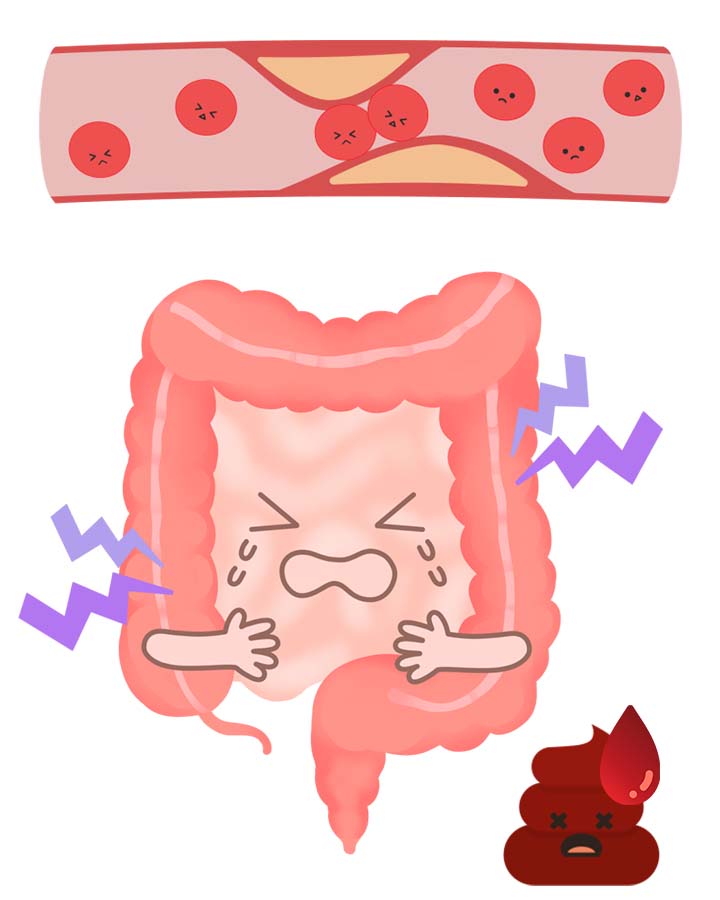 虚血性腸炎