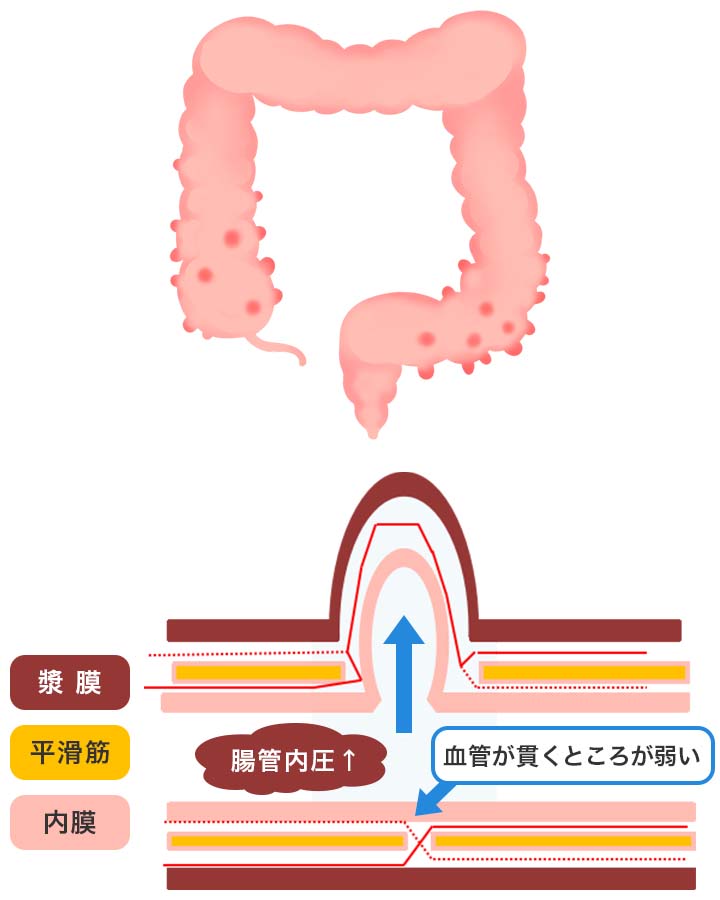 大腸憩室症
