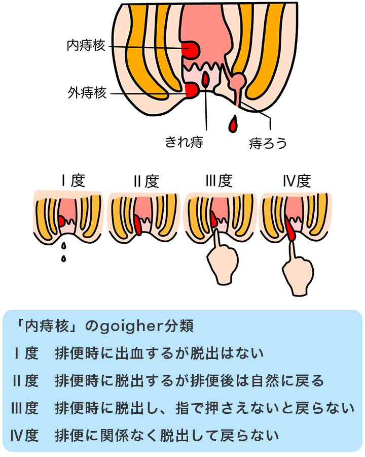 肛門の病変